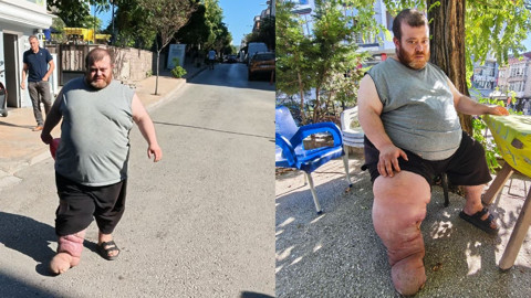 Fil hastası Kazım'ın tedavisi için 82 kilo vermesi gerekiyor