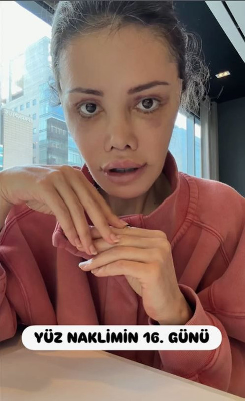 Yüz nakli operasyonu geçiren Didem Ceran'ın son hali olay oldu: "Bebeksiyim, yapay zeka değil" - Resim: 5