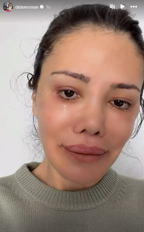 Yüz nakli operasyonu geçirmişti! Didem Ceran'dan kötü haber geldi - Resim: 8