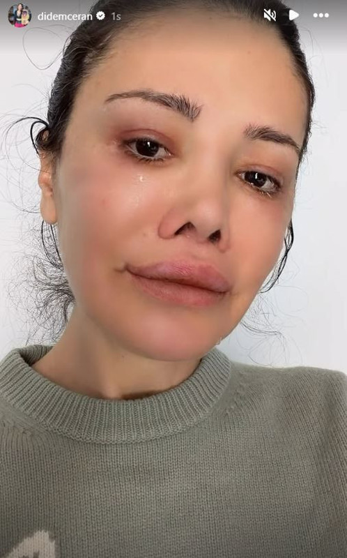 Yüz nakli operasyonu geçirmişti! Didem Ceran'dan kötü haber geldi - Resim: 6