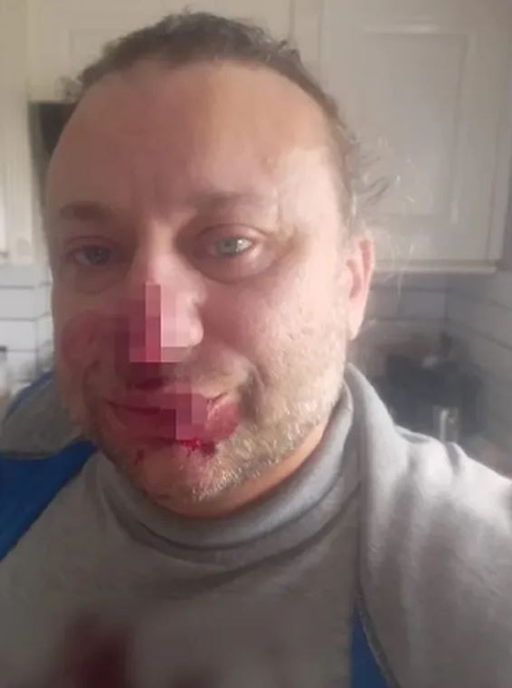 Pitbull saldırısına uğramıştı! Onur Akay'dan kötü haber geldi - Resim: 3