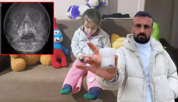 Akıllara durgunluk veren olay! 5 yaşındaki Polen 2 yıl burnunda tırnak makası zinciriyle yaşadı