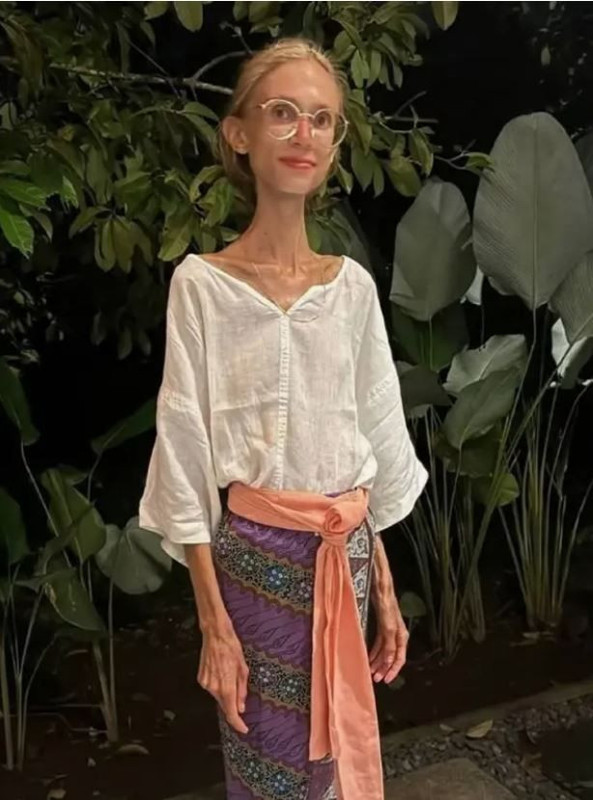 22 kiloya kadar düşmüştü! Sosyal medya fenomeni hayatını kaybetti - Resim: 1