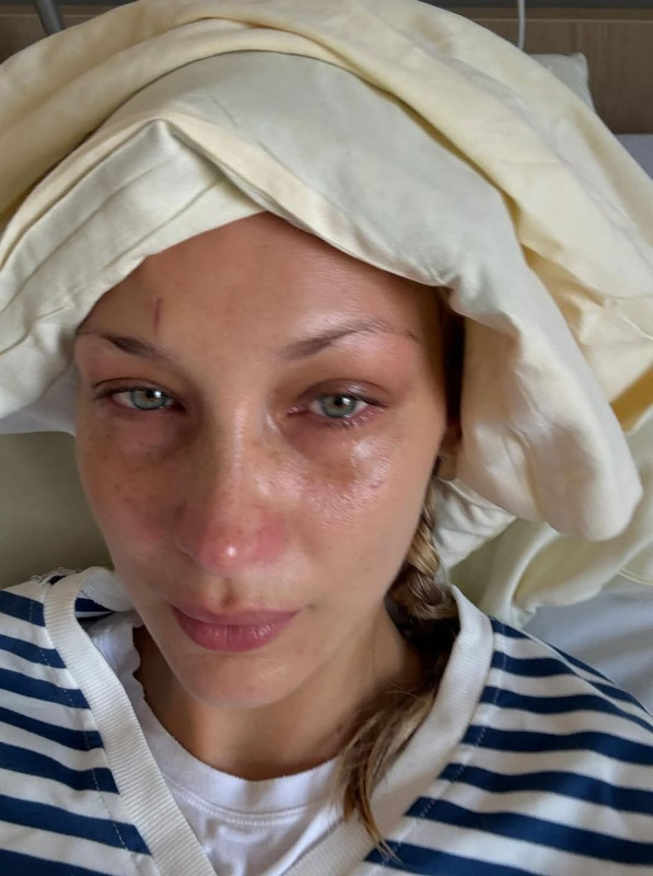 Lyme hastalığıyla mücadele ediyordu! Ünlü model Bella Hadid'den yürek burkan paylaşım - Resim: 3
