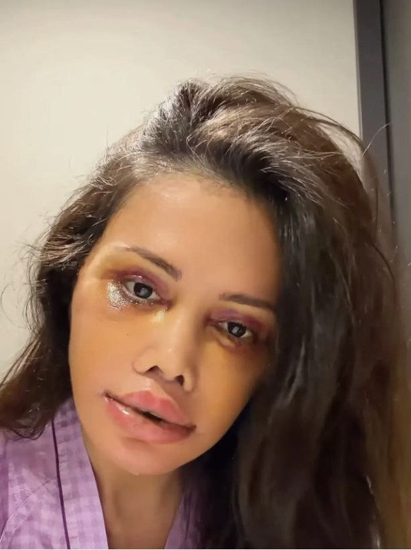 Yüz nakli operasyonu geçiren Didem Ceran'ın son hali olay oldu: "Bebeksiyim, yapay zeka değil" - Resim: 6