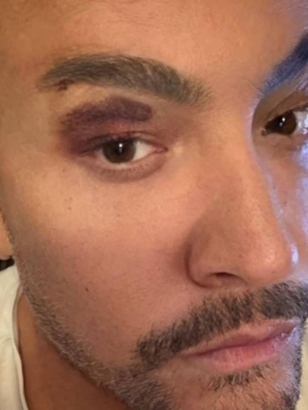 Ünlü Türk sanatçıdan kötü haber! Kaza geçirdi - Resim: 5