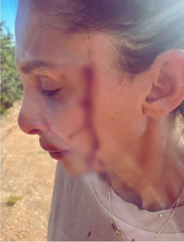 Can Yaman'ın sevgilisi kanlar içinde paylaşımda bulundu! "Artık susmayacağım" diyerek uğradığı şiddeti anlattı - Resim: 5