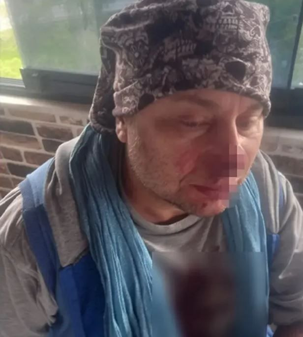 Pitbull saldırısına uğramıştı! Onur Akay'dan kötü haber geldi - Resim: 4