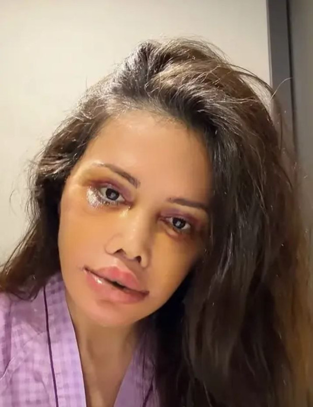 Yüz nakli operasyonu geçirmişti! Didem Ceran'dan kötü haber geldi - Resim: 3