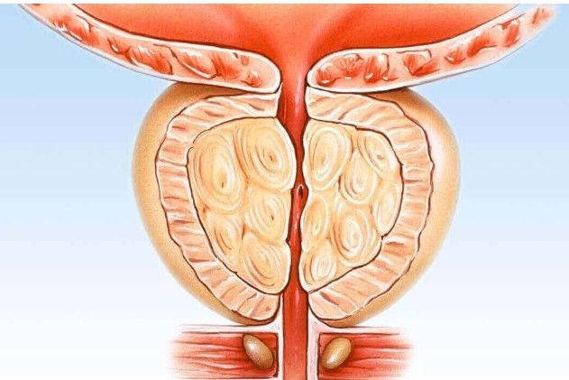 Prostat artık cinselliğe engel değil! İşte merak edilen holep tedavisi - Resim: 1