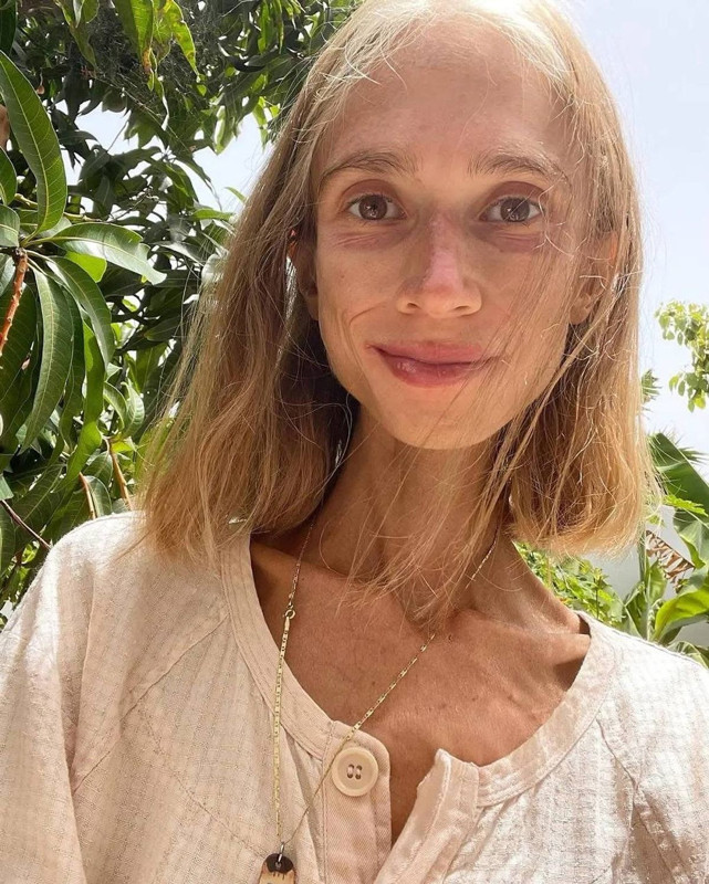 22 kiloya kadar düşmüştü! Sosyal medya fenomeni hayatını kaybetti - Resim: 5