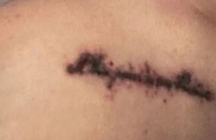Genç kadın yazar, estetik merkezinde kabusu yaşadı! Eve gidince koluna bakınca dehşet manzarayı gördü - Resim: 5