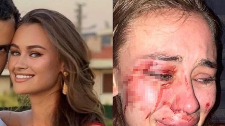 Dünyaca ünlü model Daria Kyryliuk Çeşme'de saldırıya uğradı - Resim: 1