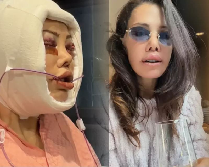 Yüz nakli operasyonu geçiren Didem Ceran'ın son hali olay oldu: "Bebeksiyim, yapay zeka değil" - Resim: 3