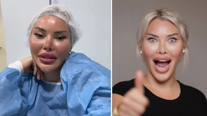 Estetik bağımlılığı bunu da yaptırdı! Ünlü fenomen Pınar Özkurteller gözlerini maviye boyattı, son hali olay oldu - Resim: 4