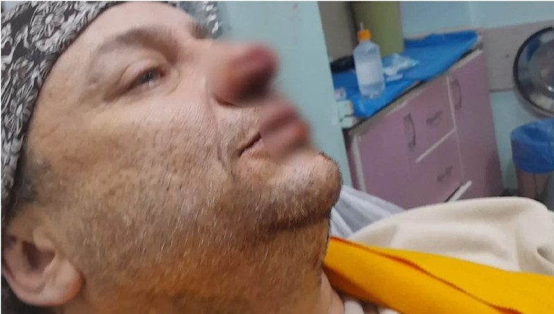 Pitbull saldırısına uğramıştı! Onur Akay'dan kötü haber geldi - Resim: 2