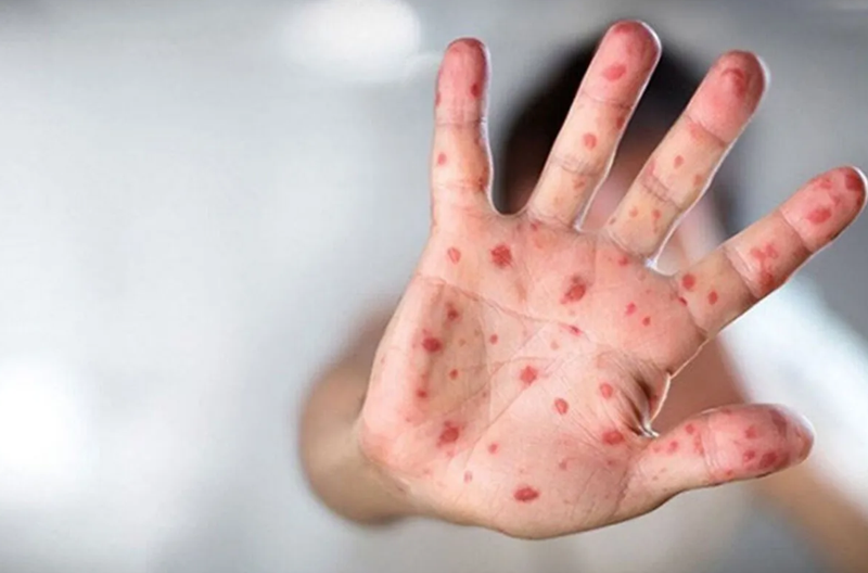 Okullarda kırmızı alarm! Çocuğunuzda bu belirtiler varsa dikkat: O hastalıkta dikkat çeken artış yaşanıyor - Resim: 4