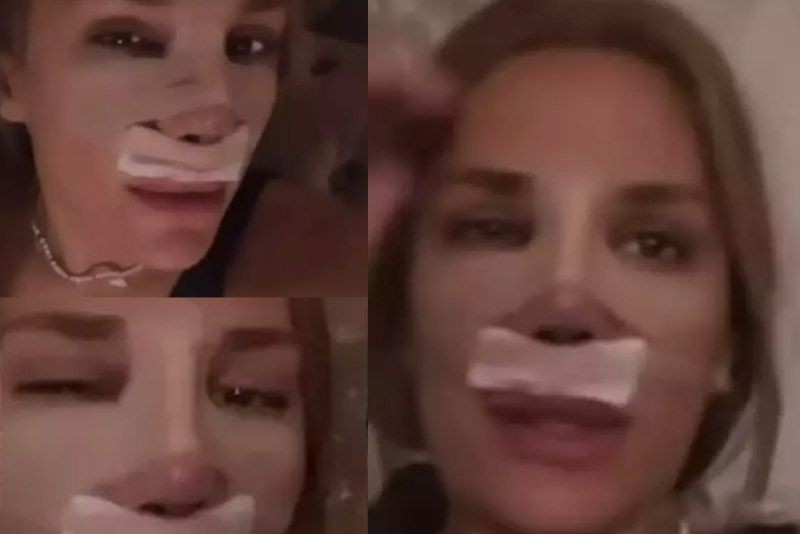 Survivor'dan diskalifiye edilen Almeda Baylan burun estetiği oldu! Operasyon sonrası ilk görüntüsü ortaya çıktı - Resim: 5