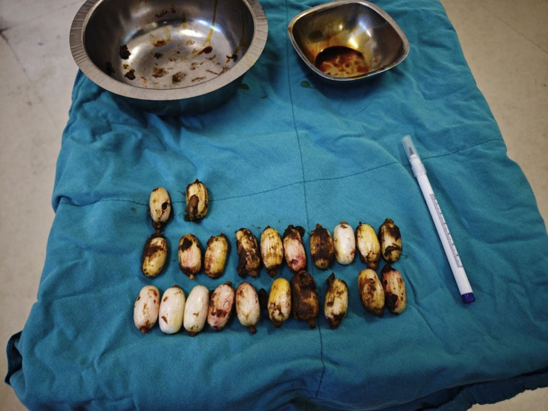 Röntgende ortaya çıktı! Midesinden çıkanlar şoke etti - Resim: 3