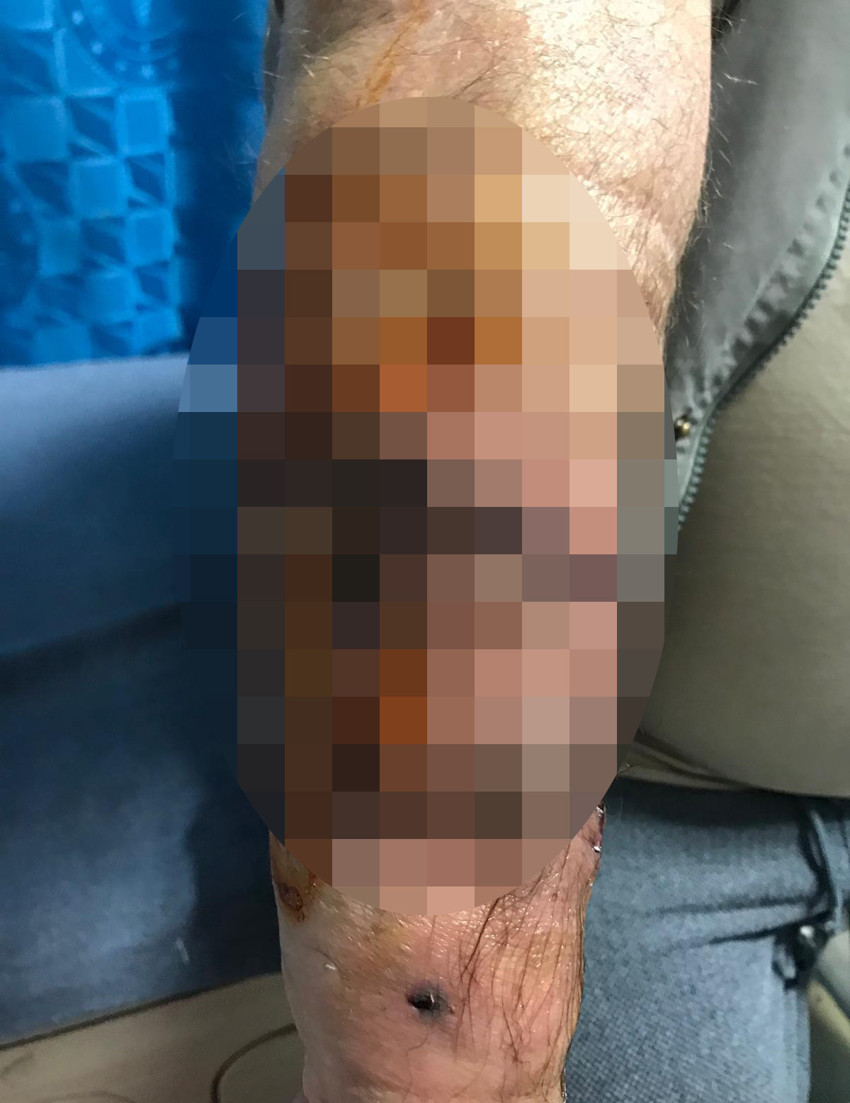 Yürüyüş yaparken köpeklerin saldırısına uğradı: 76 dikiş atıldı! - Resim : 1