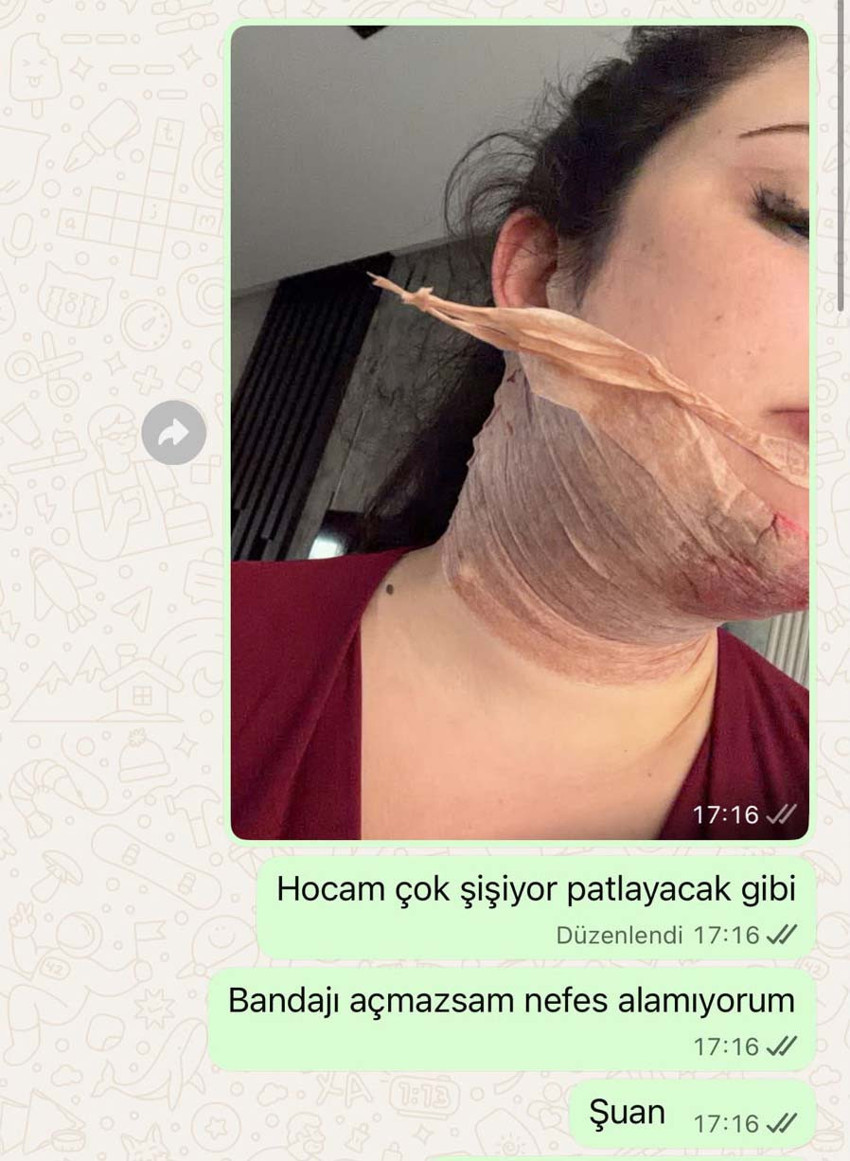 Estetik yaptırmak istedi kabusu yaşadı! Yüzü felç oldu, saçları döküldü, akciğeri söndü: Hocam nefes alamıyorum! - Resim : 2