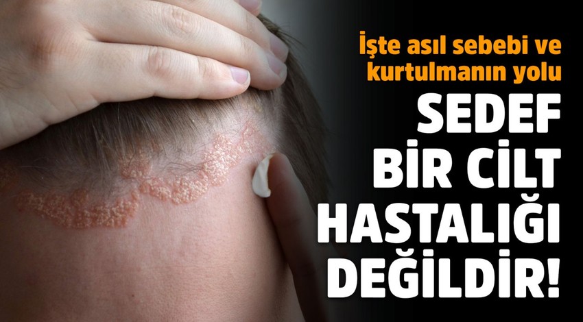 Sedef cilt hastalığı değildir! İşte kurtulmanın yolu