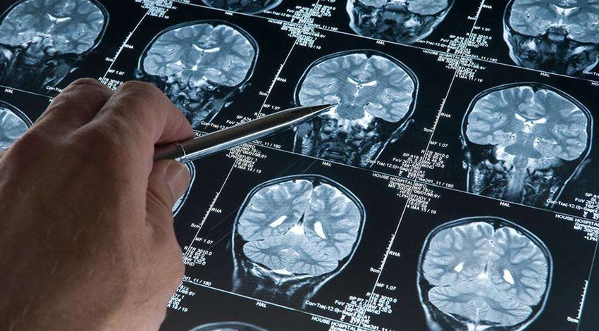 Alzheimer araştırmalarında yeni keşif: Riski artıran genetik varyant bulundu!