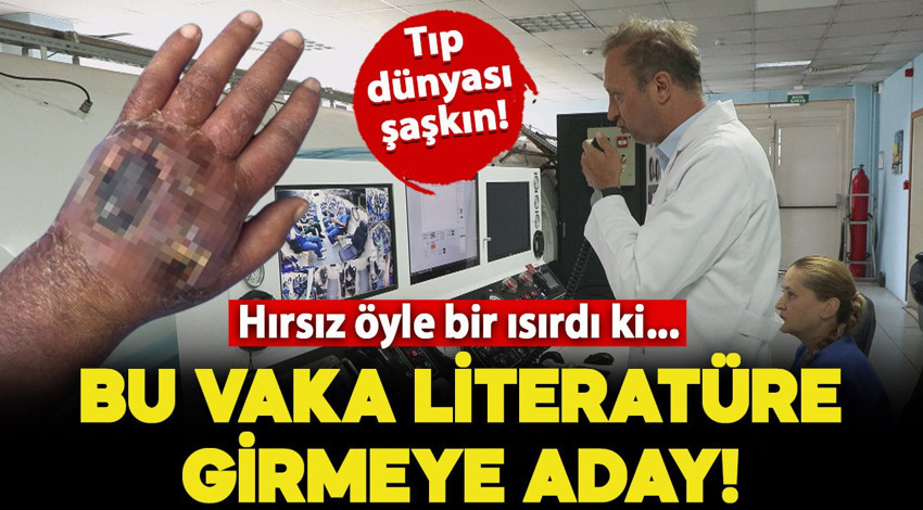 Tıp dünyası şaşkın! Vaka literatüre girmeye aday: Hırsız öyle bir ısırdı ki, amputasyondan döndü