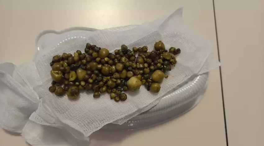 Safra kesesinden yüzlerce taş çıkarıldı!