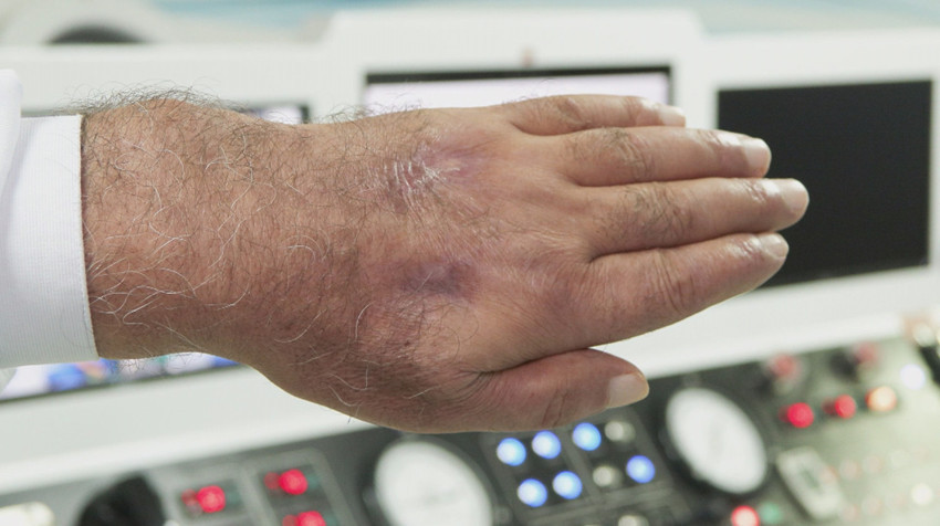 Tıp dünyası şaşkın! Vaka literatüre girmeye aday: Hırsız öyle bir ısırdı ki, amputasyondan döndü - Resim : 4