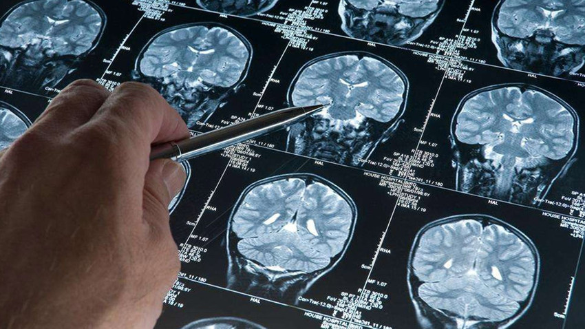 Alzheimer araştırmalarında yeni keşif: Riski artıran genetik varyant bulundu!