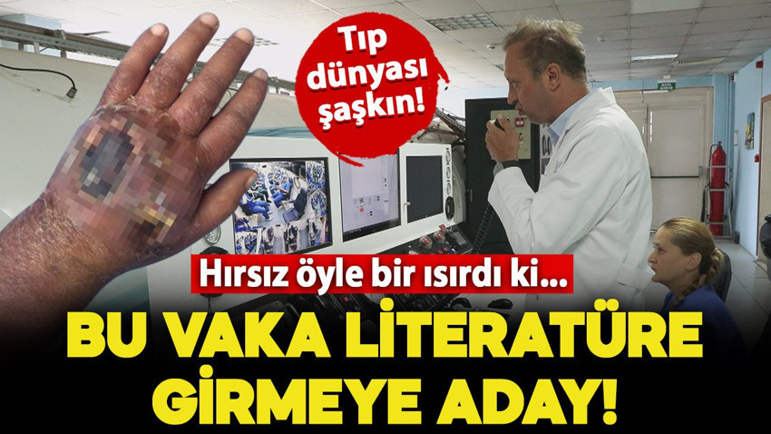 Tıp dünyası şaşkın! Vaka literatüre girmeye aday: Hırsız öyle bir ısırdı ki, amputasyondan döndü