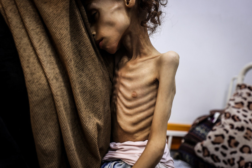 Gazze'de açlık yavaş yavaş öldürüyor!  9 yaşındaki Meryem 10 kiloya düştü! 'Bu benim kızım mı?' - Resim : 3