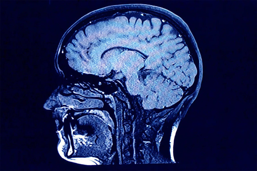 Alzheimer’dan korunmanın yolu basit: 5 yumurta - Resim : 1