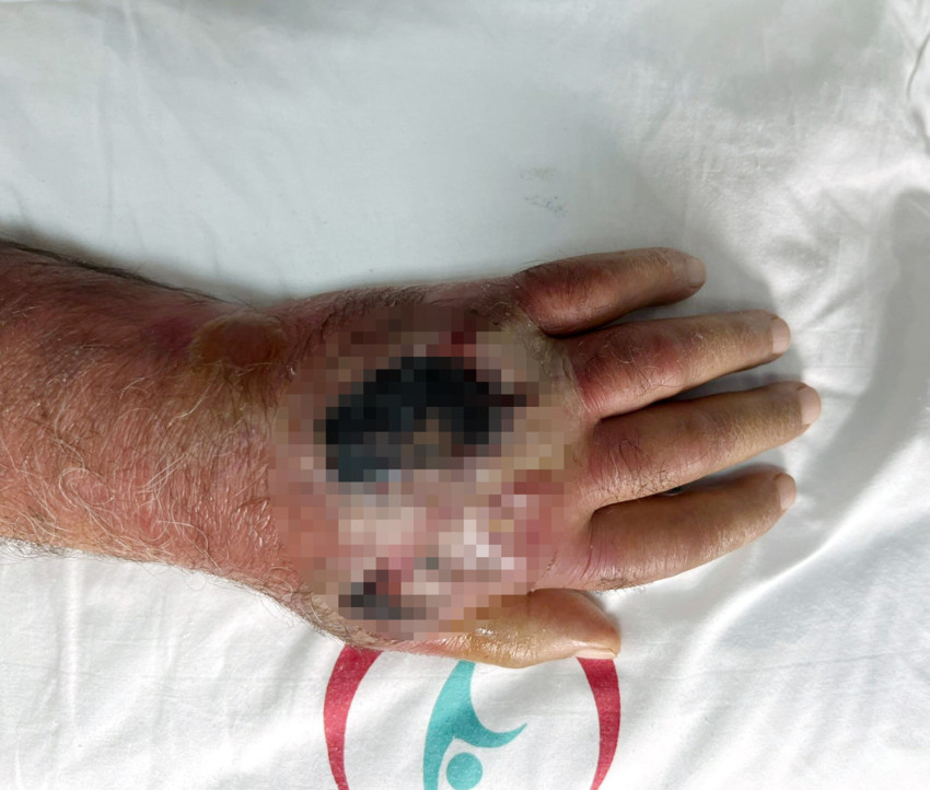 Tıp dünyası şaşkın! Vaka literatüre girmeye aday: Hırsız öyle bir ısırdı ki, amputasyondan döndü - Resim : 2