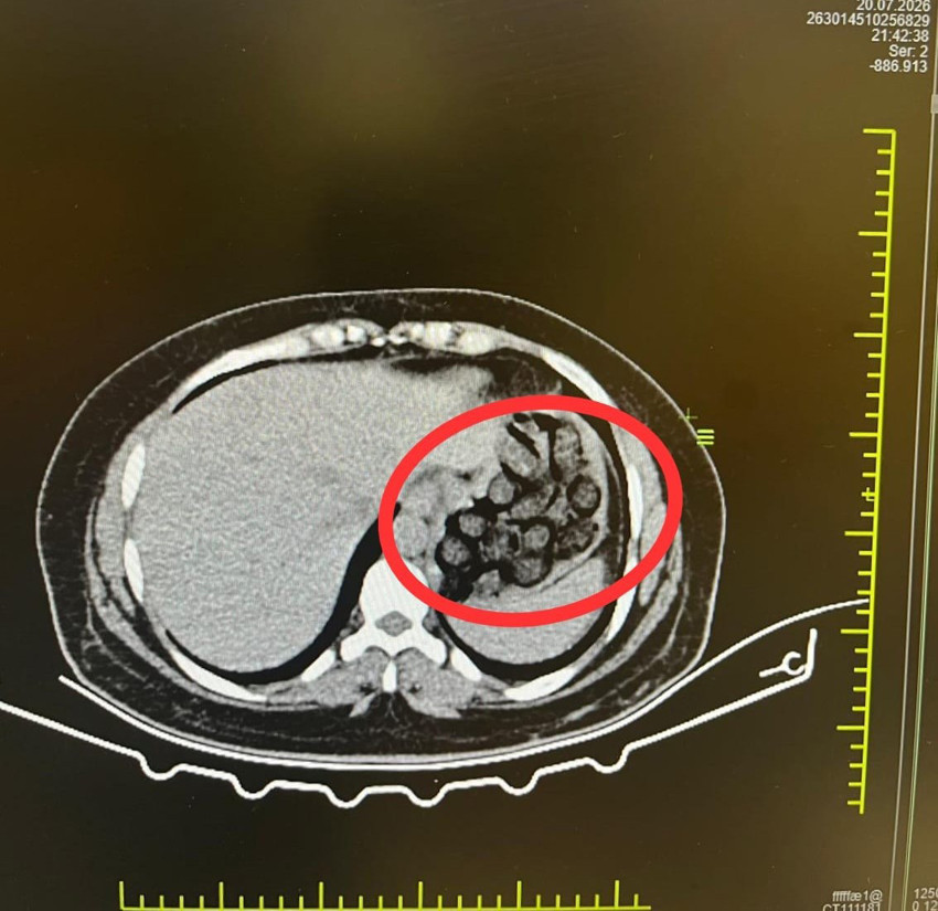 Zehir tacirlerine darbe: Midesinden 432 gram metamfetamin çıktı - Resim : 2