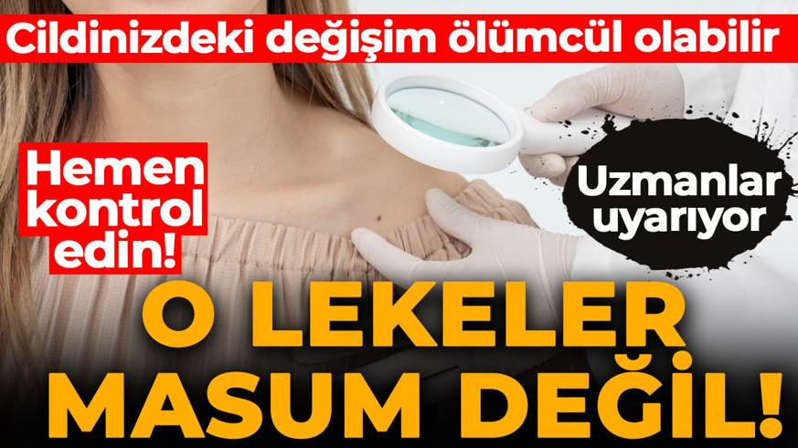 Cildinizdeki o küçük değişim ölümcül olabilir! Uzmanlar uyarıyor: Görmezden gelmeyin