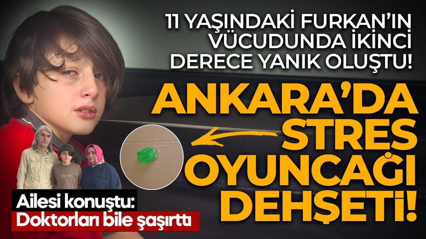 Ankara'da stres oyuncağı hastanelik etti! 11 yaşındaki Furkan'ın ayağında ikinci derece yanık oluştu